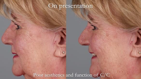 Replacing Madeline’s Complete denture FULL PROTOCOL