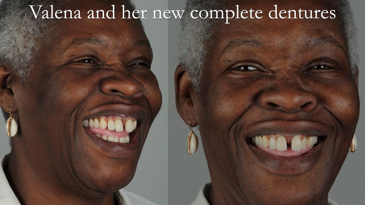 Newsletter 53 showing the making and fitting of ultra life-like dentures for Valena