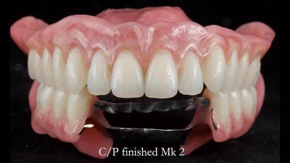 Newsletter 52 Managing Jo’s failing dentition with extractions and Mk 1/Mk 2 complete upper dentures and lower partial dentures FULL PROTOCOL