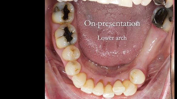 Newsletter 56 showing the making and fitting of a bilateral free end saddle upper removable partial denture (RPD) for patient with pemphigus