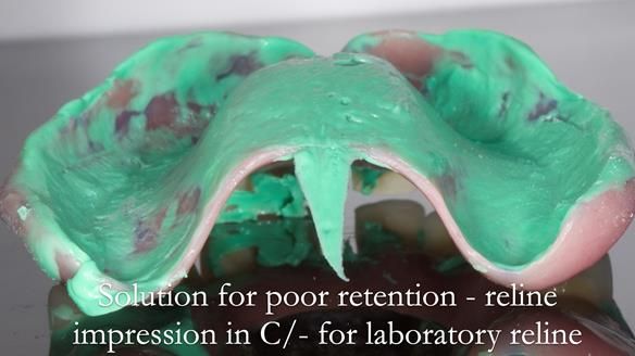 Newsletter 53 showing the making and fitting of ultra life-like dentures for Valena