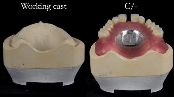 Newsletter 53 showing the making and fitting of ultra life-like dentures for Valena