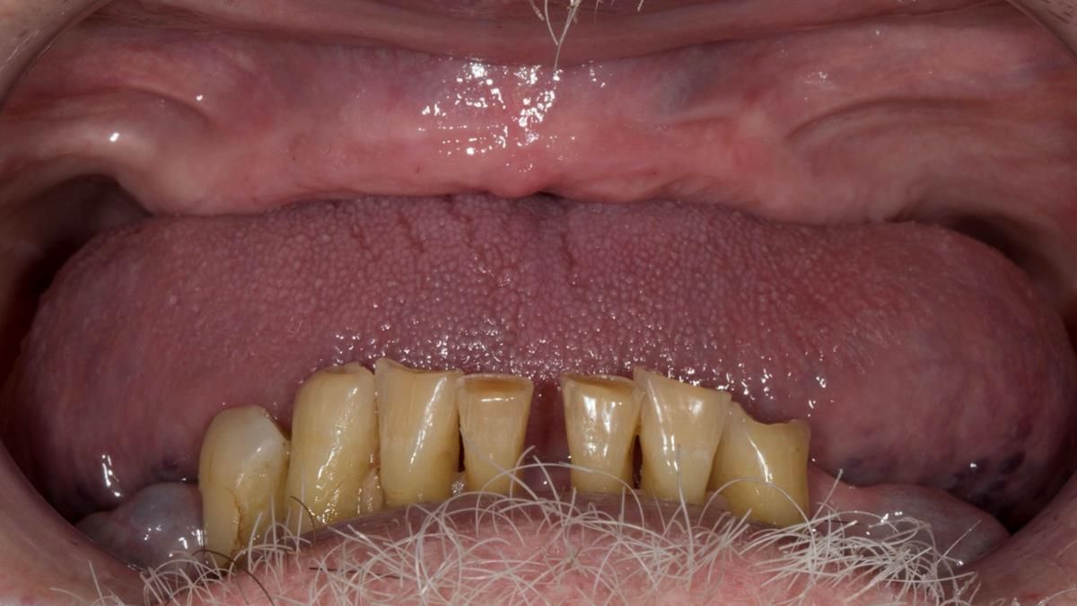 Newsletter 87 – Father Peter: A Partial Denture that needed Minor Miracle