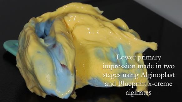 Finlay's Newsletter 61 provision of a lower unilateral free end saddle metal based partial denture for Joyce