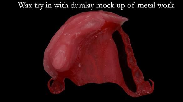 Upper metal base partial denture/occlusal stabilisation splint/obturator - full protocol