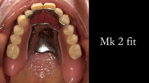 Finlay's Case Study Newsletter 40 - Immediate Mk 1 RPD to Definitive Mk 2 RPD - full protocol