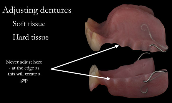 Figure 26 When fitting I always adjust below area where the denture touches the tooth as in the photograph. This prevents a gap forming between the denture and the teeth when fitted as shown in figure 36
