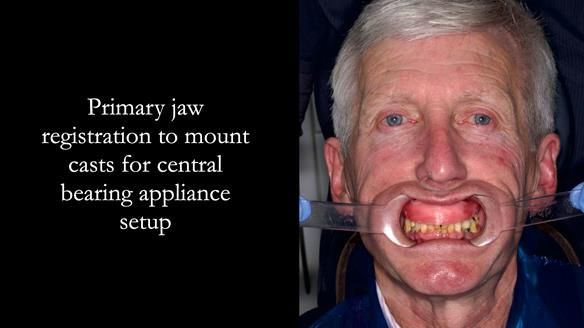 Newsletter 77: Jeremy’s case – immediate complete upper denture