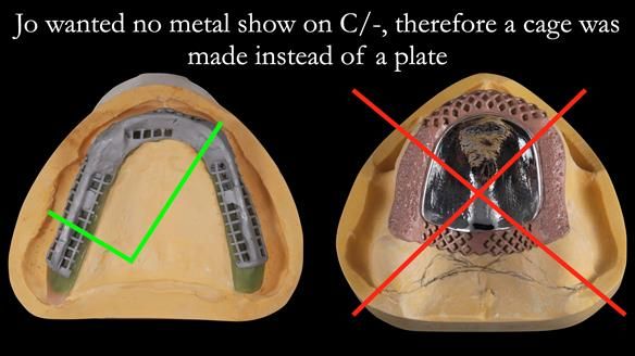 Newsletter 52 Managing Jo’s failing dentition with extractions and Mk 1/Mk 2 complete upper dentures and lower partial dentures FULL PROTOCOL