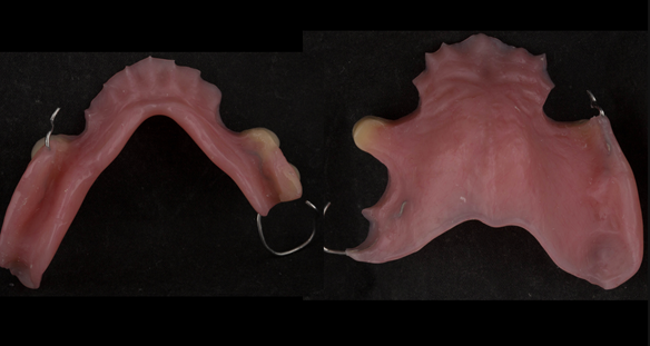 Figure 24 Finished immediate dentures - intaglio surfaces.