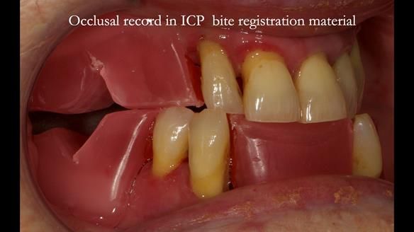 Finlay's Case Study Newsletter 40 - Immediate Mk 1 RPD to Definitive Mk 2 RPD - full protocol