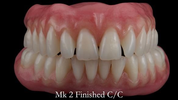 Replacing Madeline’s Complete denture FULL PROTOCOL