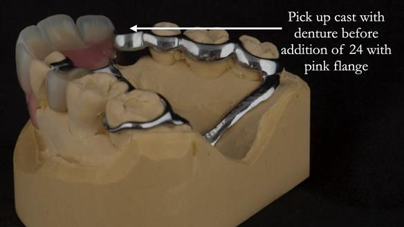 Finlay's Newsletter 63 Case study provision of metal based Scandinavian RPD - functional 10 years on