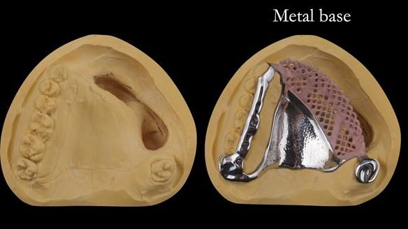 Upper metal base partial denture/occlusal stabilisation splint/obturator - full protocol