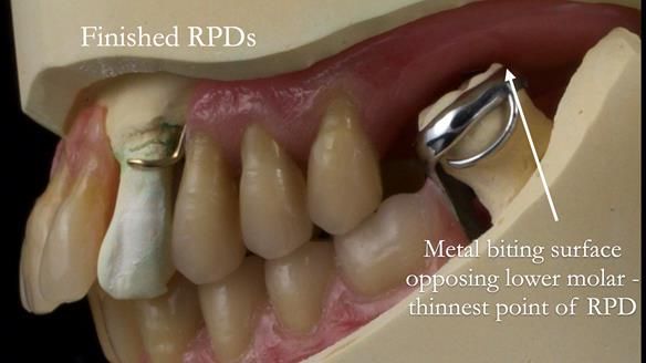 Finlay's Newsletter 59 Ultra hard partial dentures made for Gill