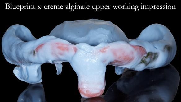 Newsletter 52 Managing Jo’s failing dentition with extractions and Mk 1/Mk 2 complete upper dentures and lower partial dentures FULL PROTOCOL