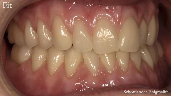 Newsletter 75: Marion’s case - Step-by-step complete denture workflow