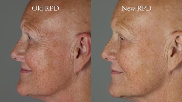 Newsletter 81 - Pam’s Story — how a partial denture changed her life (+ live walkthrough this Thursday)