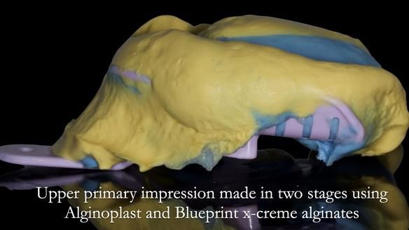 Newsletter 53 showing the making and fitting of ultra life-like dentures for Valena