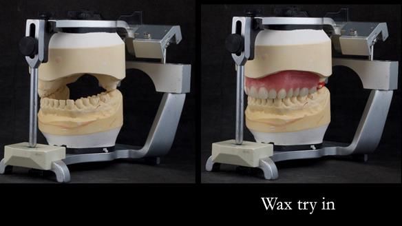 Upper metal base partial denture/occlusal stabilisation splint/obturator - full protocol