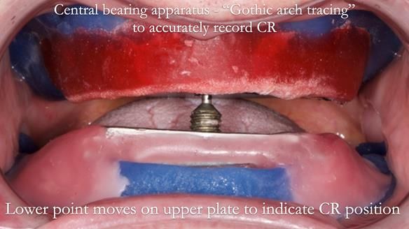 Newsletter 80 - Gordon’s dentures: the one case in 1,000 where my technique failed