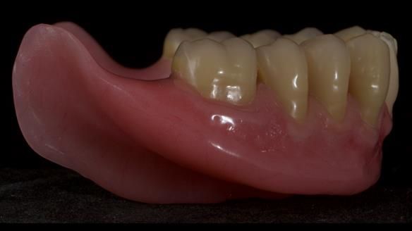 Newsletter 83: Sheila’s Complete Denture Success