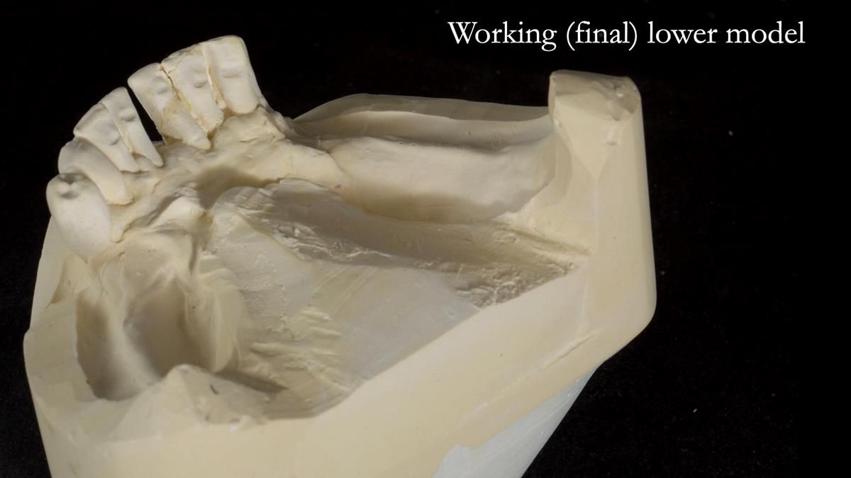 Newsletter 87 – Father Peter: A Partial Denture that needed Minor Miracle