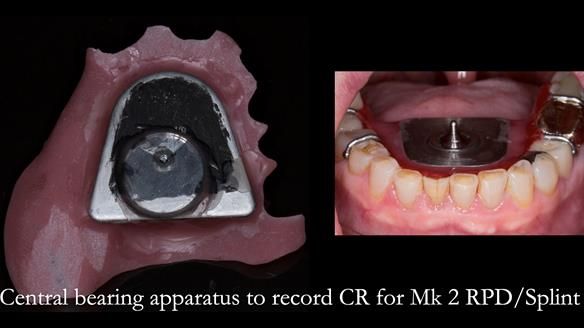 Newsletter 51 Managing Anne’s failing dentition with distal extension base RPD/Splint FULL PROTOCOL