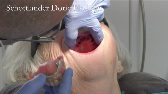 Figure 34 Checking the fit with light bodied silicone