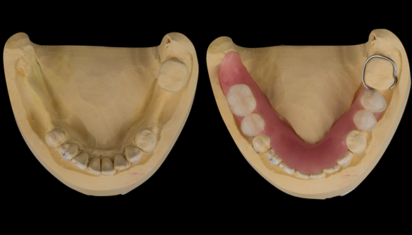 Figure 23 Finished lower immediate denture. Schottlander Enigmalife teeth.