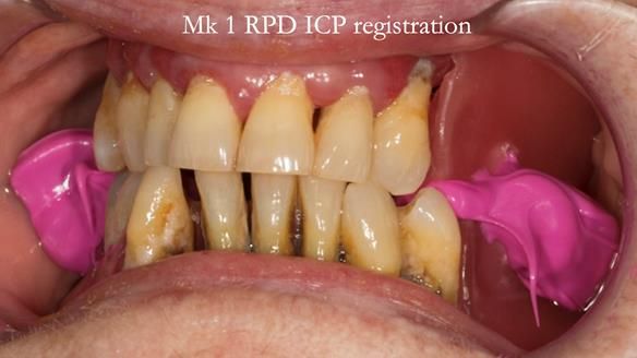 Finlay's Case Study Newsletter 40 - Immediate Mk 1 RPD to Definitive Mk 2 RPD - full protocol