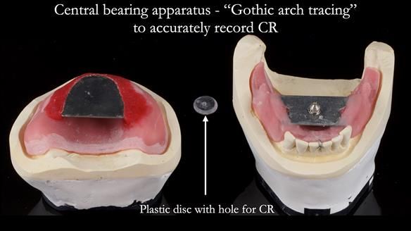Newsletter 52 Managing Jo’s failing dentition with extractions and Mk 1/Mk 2 complete upper dentures and lower partial dentures FULL PROTOCOL