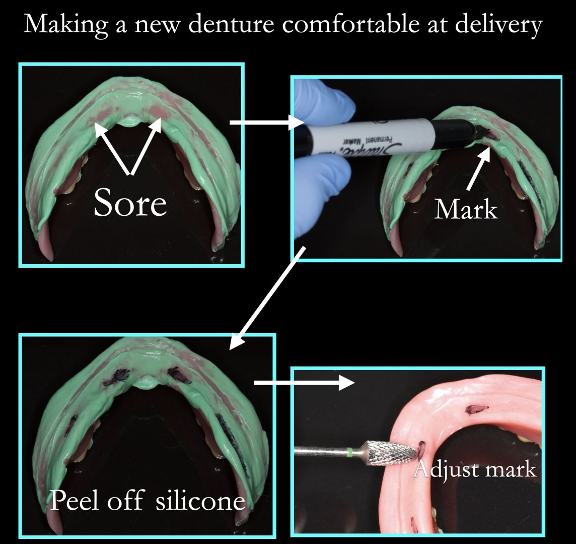 Making new dentures comfortable with silicone fit check