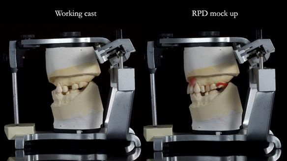 Newsletter 81 - Pam’s Story — how a partial denture changed her life (+ live walkthrough this Thursday)