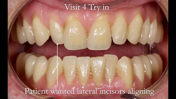 Complete denture Class II div 2 deep overbite Newsletter 39