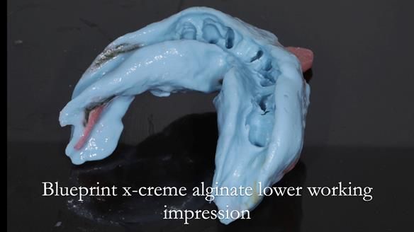 Newsletter 54 case presentation upper complete denture and lower Scandinavian designed hygienic partial denture for David