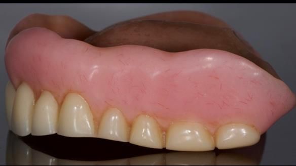 Newsletter 80 - Gordon’s dentures: the one case in 1,000 where my technique failed