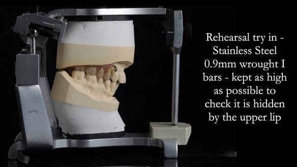 Newsletter 56 showing the making and fitting of a bilateral free end saddle upper removable partial denture (RPD) for patient with pemphigus