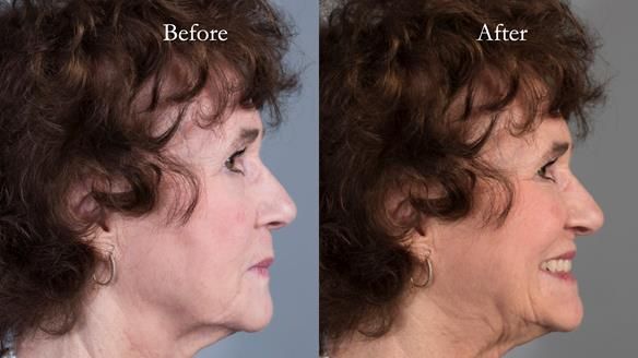 Newsletter 75: Marion’s case - Step-by-step complete denture workflow