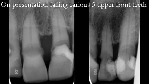 Finlay's Newsletter 62 provision of extractions and metal based complete dentures for Rafique