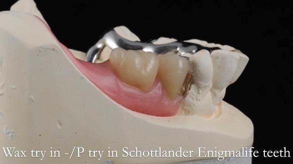 Newsletter 54 case presentation upper complete denture and lower Scandinavian designed hygienic partial denture for David