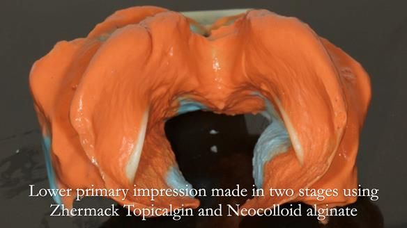 Complete denture Class II div 2 deep overbite Newsletter 39
