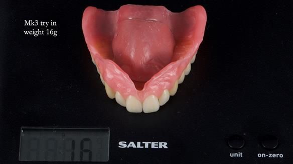 Newsletter 77: Jeremy’s case – immediate complete upper denture
