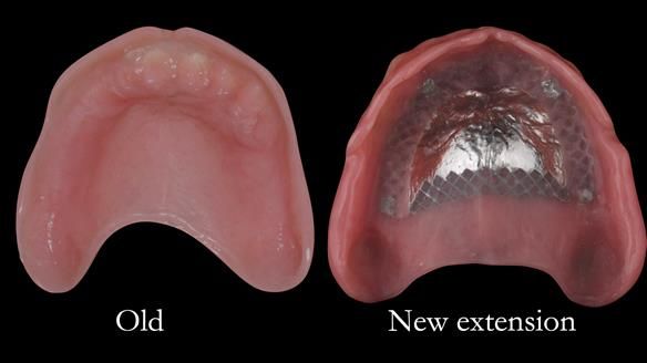 Complete denture Class II div 2 deep overbite Newsletter 39