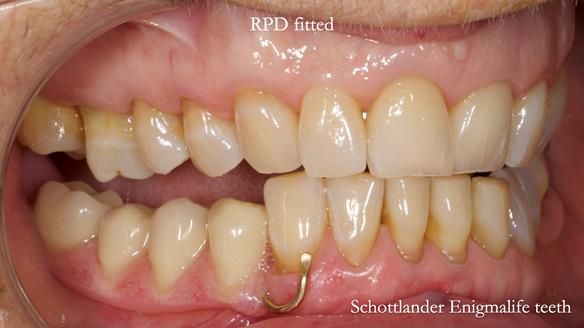 Finlay's Newsletter 61 provision of a lower unilateral free end saddle metal based partial denture for Joyce