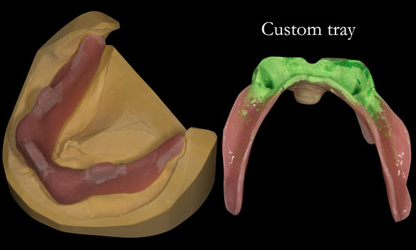 Figure 15 Custom tray for lower working impression. This is adjusted so that the impression pick ups for the locators do not touch the inside of the tray when this is seated in the mouth - ensures correct seating of the tray