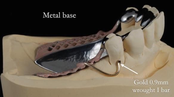 Newsletter 56 showing the making and fitting of a bilateral free end saddle upper removable partial denture (RPD) for patient with pemphigus