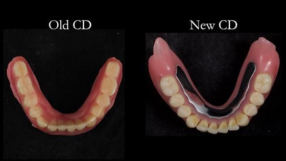 Finlay's Newsletter 62 provision of extractions and metal based complete dentures for Rafique