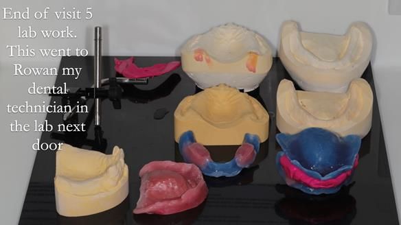 Finlay's Newsletter 62 provision of extractions and metal based complete dentures for Rafique