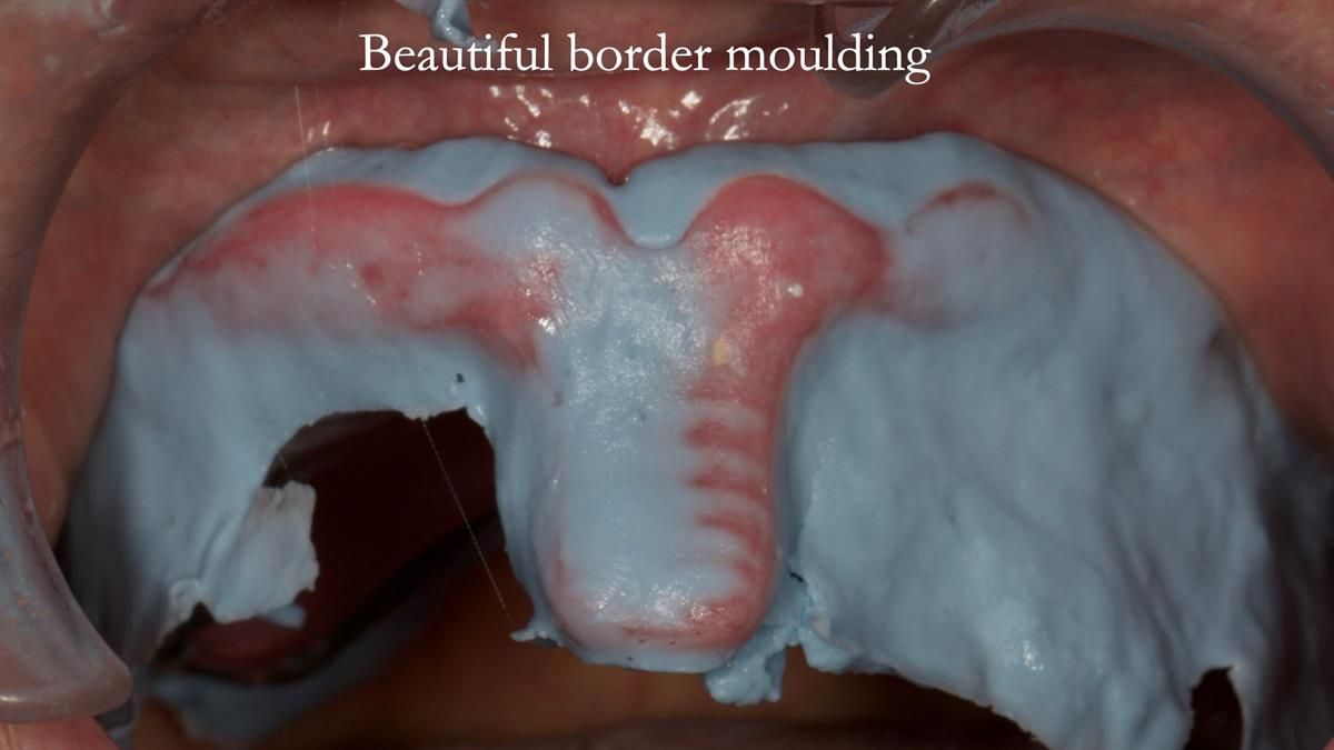 Newsletter 87 – Father Peter: A Partial Denture that needed Minor Miracle